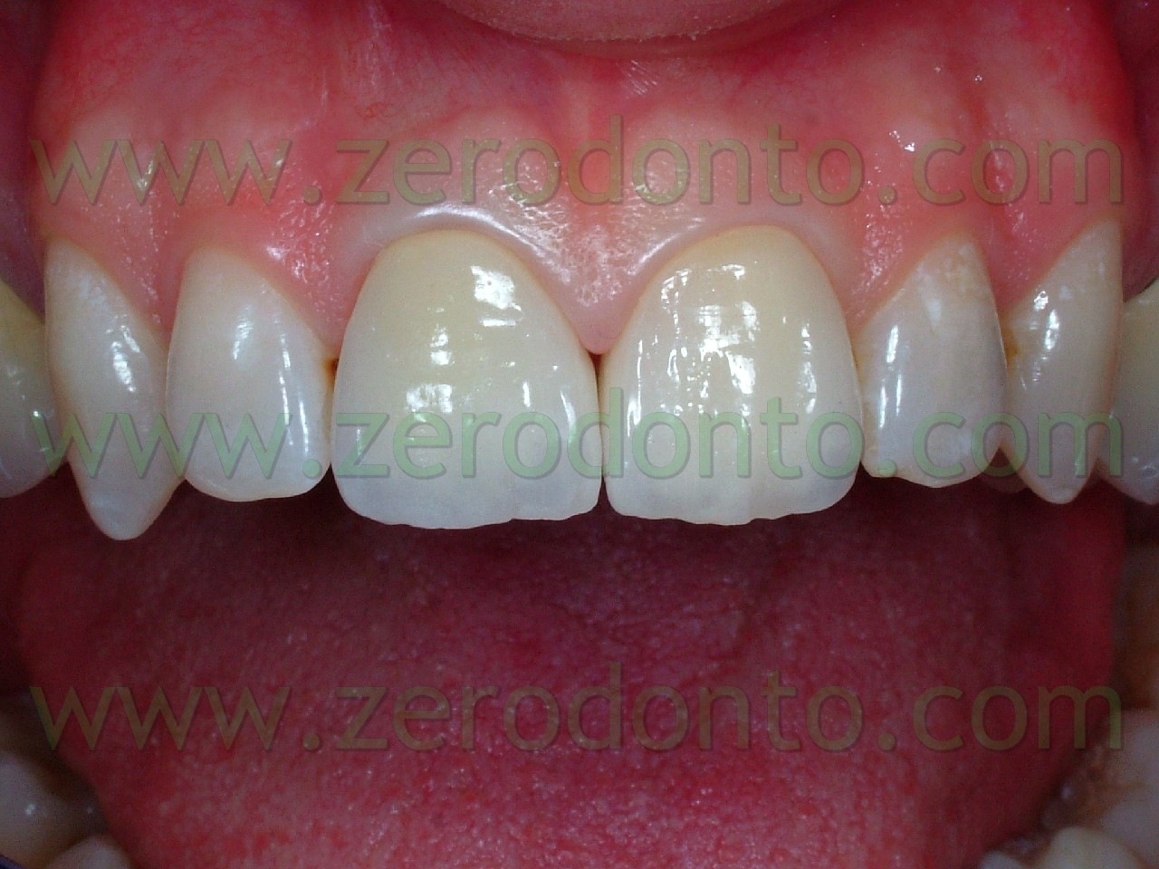 [DSCF3451dente 21 in ceramica dopo[4].jpg]