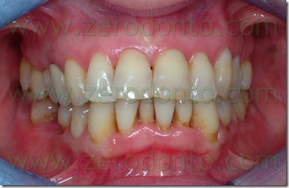 affollamento dentario