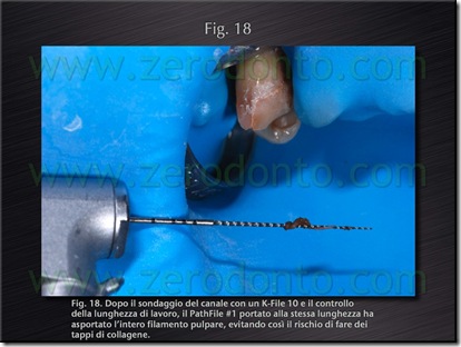 polpa dente polpa dente