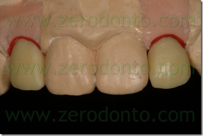 analogo straumann bone level