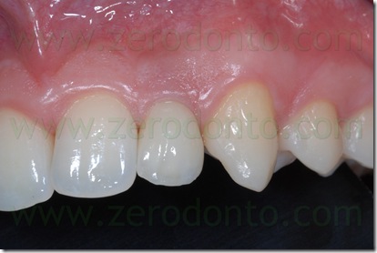 capsula zirconio
