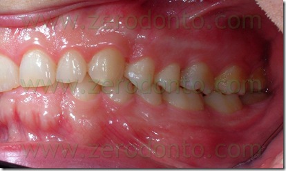 prima classe dentaria di Angle