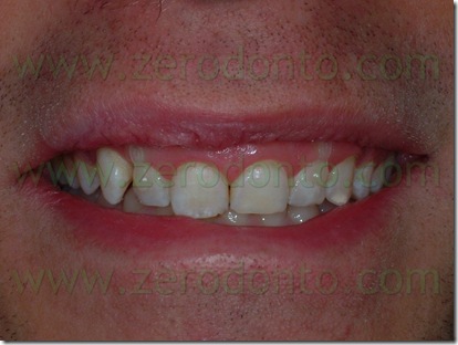 miniviti per l'intrusione dentaria
