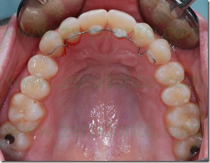 visione occlusale superiore dopo terapia invisibile