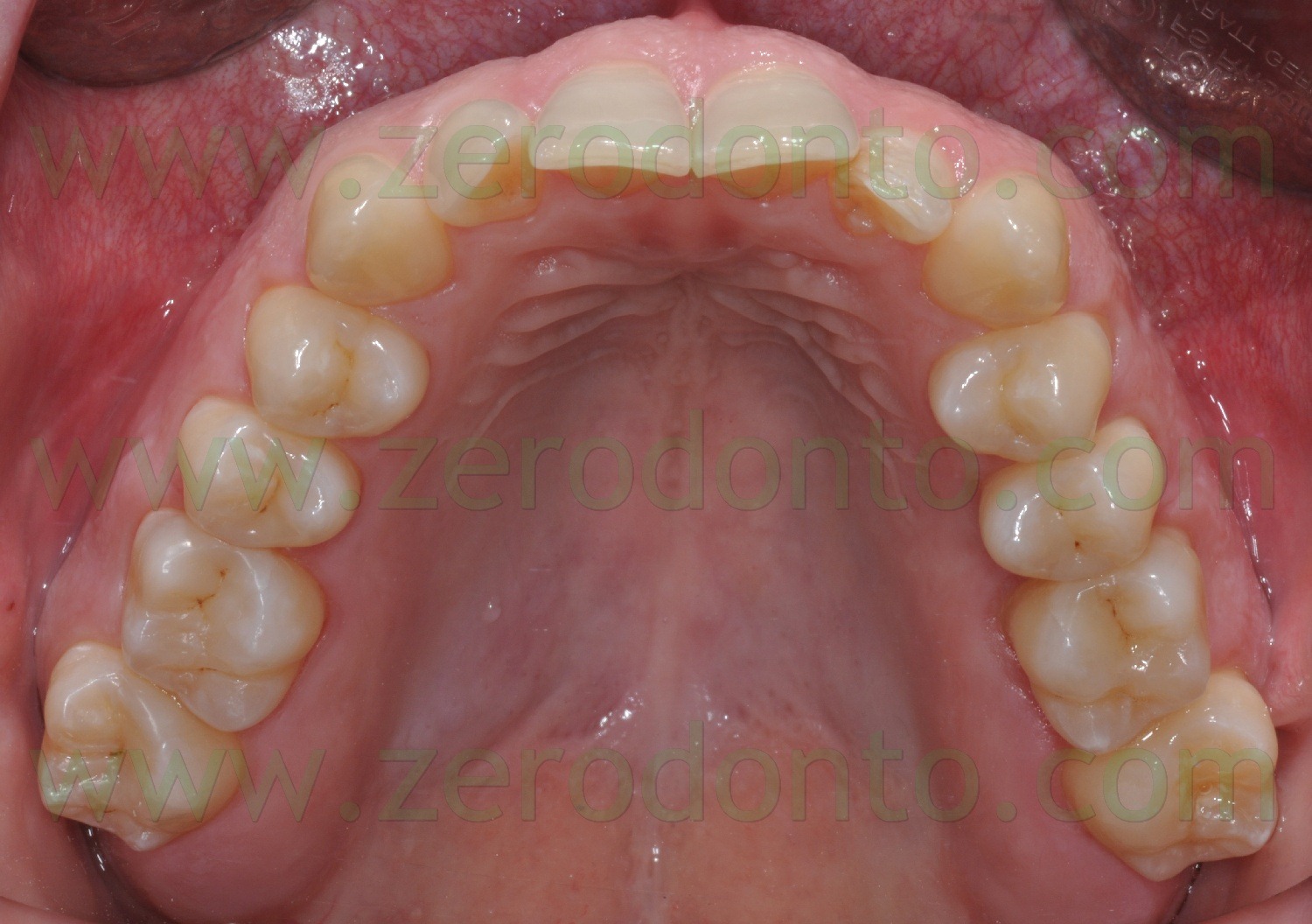 [Fig0096Rosti recall1.5aa[2].jpg]