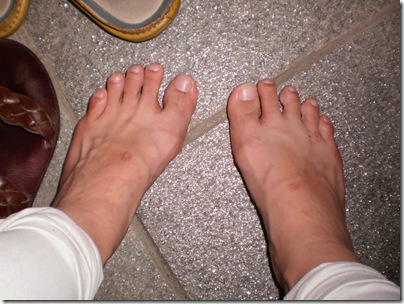 Chipped Toenail