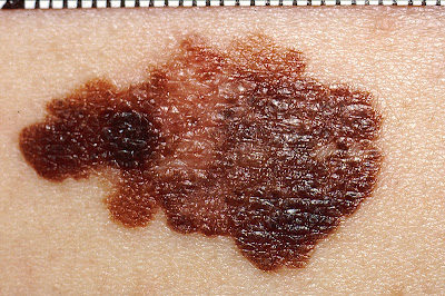 Image of melanoma