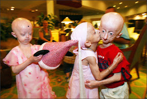 Progeria Progeria.jpg