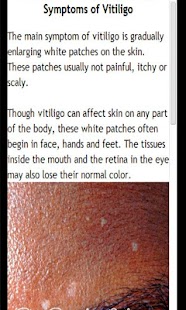How to install Vitiligo Handbook 0.1 apk for pc