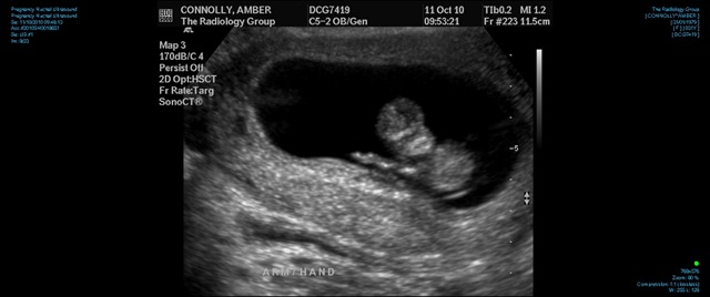[Ultrasound 0002 Waving Baby[3].jpg]