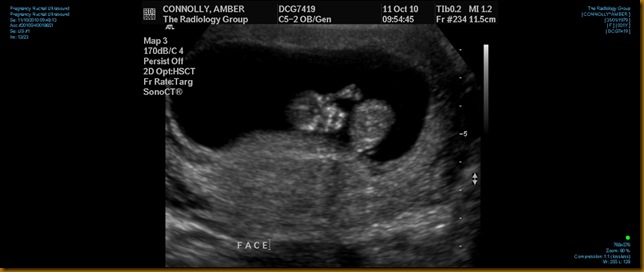 Ultrasound 0003 Skeletor Baby