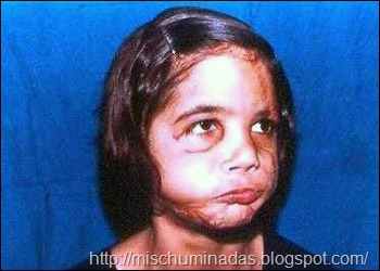 Niña sin rostro, antes y después de reimplantarle su cara Niña sin rostro, antes y después de reimplantarle su cara