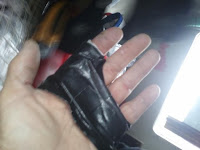 Angela's broken hand