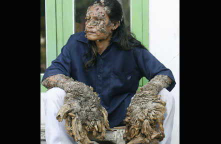 IndonesianTreeMan2.jpg