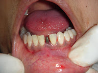 Dental Implant Procedures from dental.implantprocedure.com