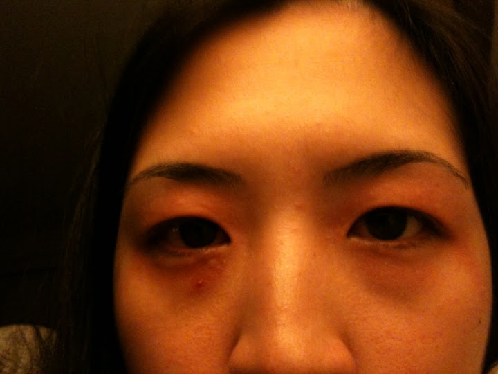 Bloodshot eyes