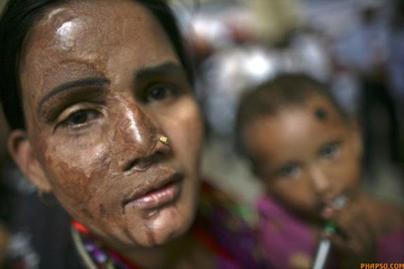 RNPS IMAGES OF THE YEAR 2009 - A survivor of an acid attack attends a rally with her child in Dhaka May 12, 2009. The Acid Survivors Foundation (ASF) of Bangladesh, which provides help and support to victims of acid violence, hosted an international conference on Tuesday to mark its 10th anniversary. About 600 acid victims from Bangladesh, Pakistan, India, Cambodia, Uganda and Nepal participated in the conference. REUTERS/Andrew Biraj (BANGLADESH SOCIETY IMAGES OF THE DAY)