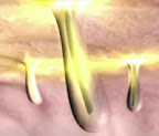 Laser removal of hair