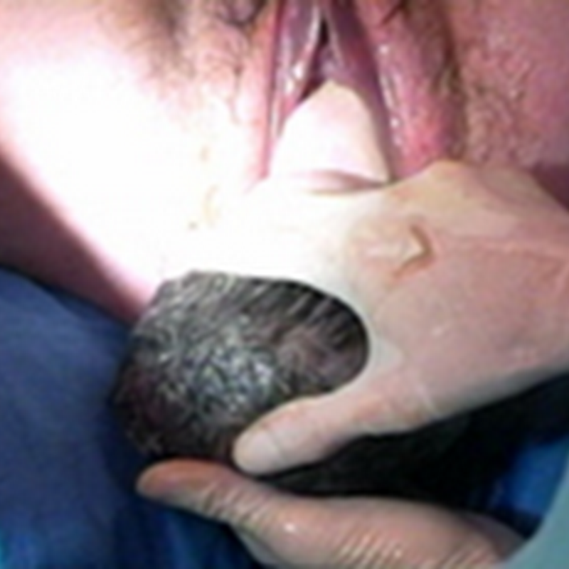 SHOULDER DYSTOCIA