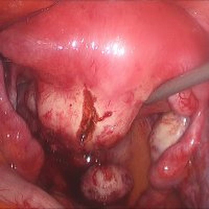 ADENOMYOSIS