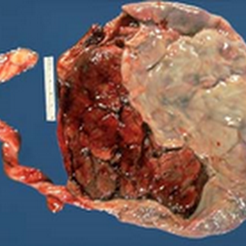 ANTENATAL COMPLICATIONS