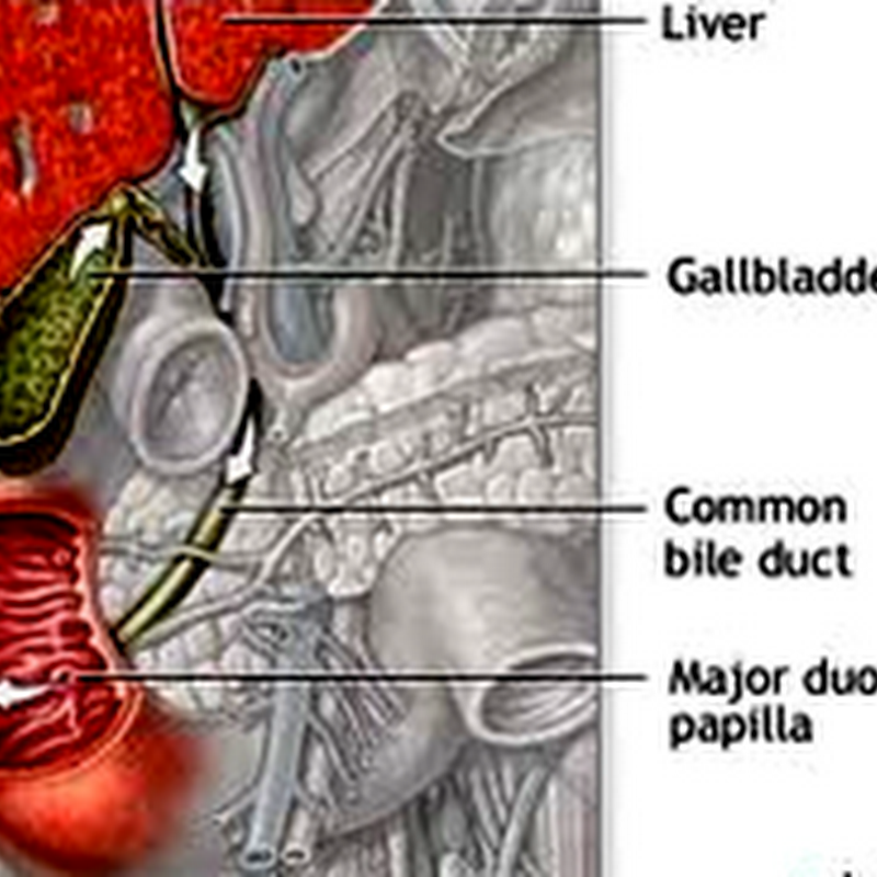 CHOLEDOCHOLITHIASIS
