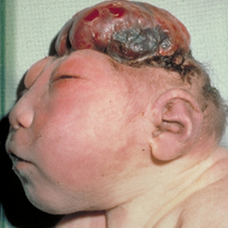 NEURAL TUBE DEFECTS and NEUROCUTANEOUS SYNDROMES