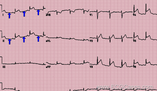 present as the P wave axis