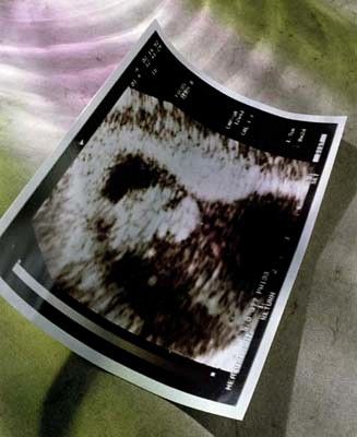 Ultrasound Image Ultrasound Image