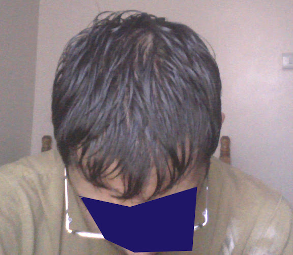 Seeing scalp when hair is wet | HairLossTalk Forums