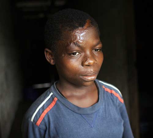 Mary, 13 anos. Jogaram ácido em seu rosto após ser acusada de ser uma bruxa. Fonte: http://guardian.co.uk