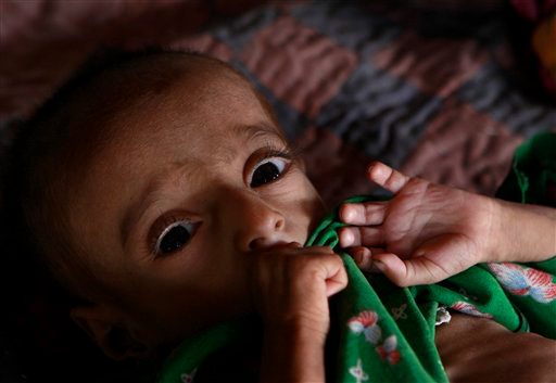 This Sept. 13, 2010 photo shows malnourished Pakistani girl Heleema, 1, at a camp for people displaced by floods in Sukkur, Sindh province, southern Pakistan. Medical experts warn the real catastrophe is moving much slower than the floodwaters. Children already sick or weak in poor rural areas prior to the floods are now fighting to stay alive as diarrhea, respiratory diseases and malaria attack their emaciated bodies. AP Photo / Aaron Favila