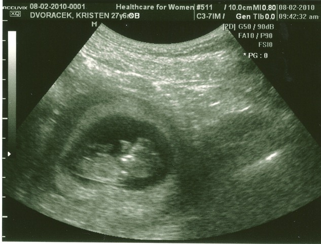 [Baby11Weeks0003[2].jpg]
