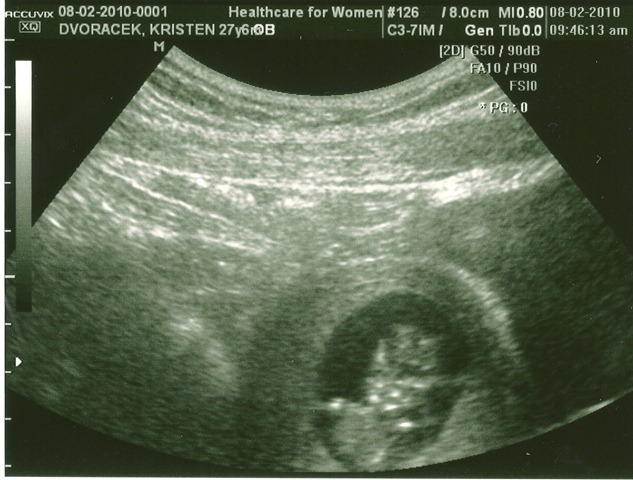 [Baby11Weeks0005[2].jpg]