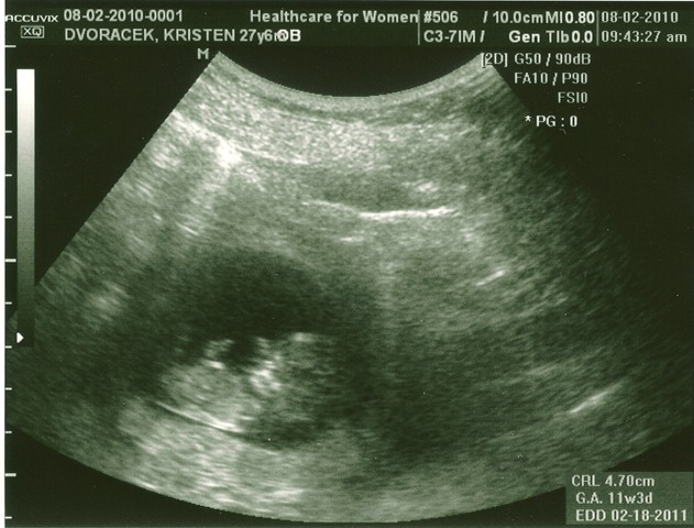 [Baby11Weeks0001[2].jpg]
