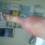 leginfection