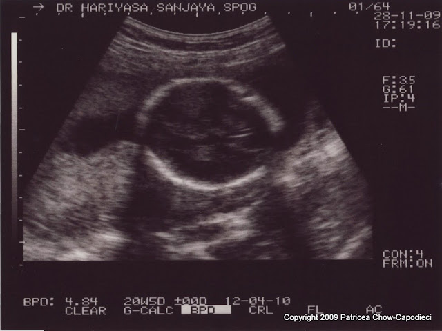 Week 19 ultrasound