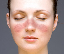 Facial rash of lupus The classis facial rash caused by lupus