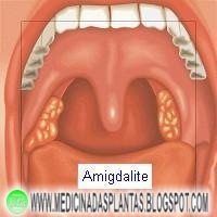 Amigdalite (Tonsilas Palatinas) – Tratamento através da medicina natural