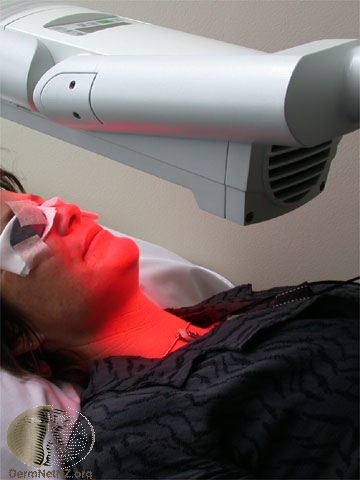 Photo Dynamic Therapy - Click to visit DermNet NZ
