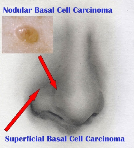 Basal Cell Carcinoma of the nose. Click to visit the creater of the base image