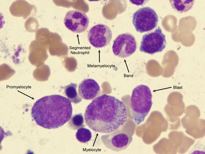 [Blast-promyelocyte-myelocyte-metamelocyte-band-segmented-100x-website-arrow[4].jpg]