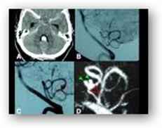 Ct+scan+brain+aneurysm