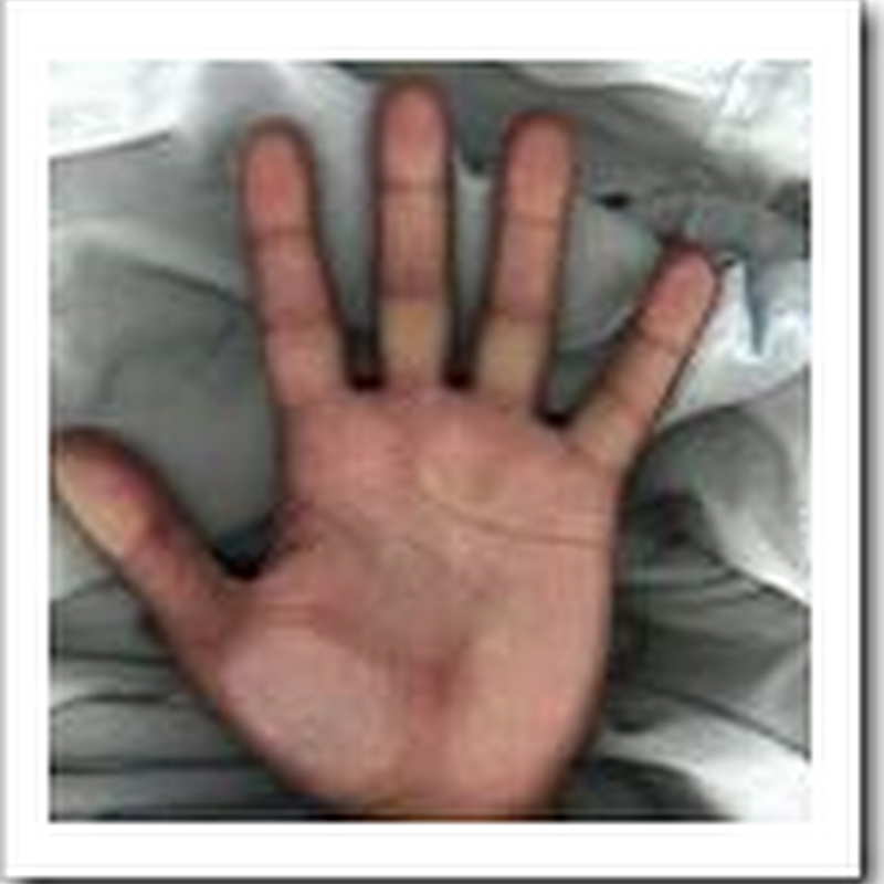 Doctor pleads guilty with Sweaty-palm surgeries - Update