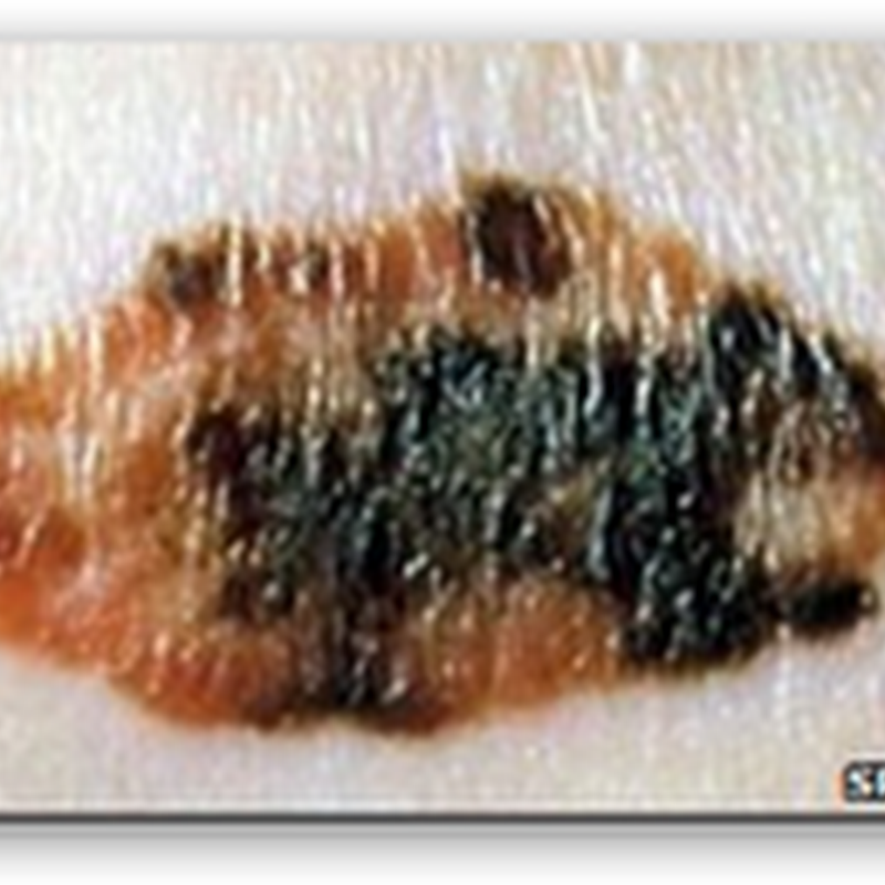 New Potential Drug to Treat advanced Melanoma