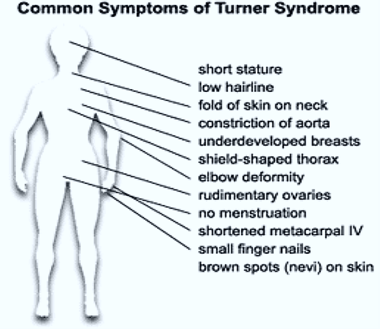 turner-syndrome1