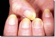 yellow_nails