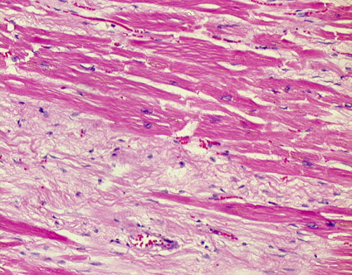 myocardial profusion