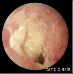 Stenotic Ear Canal
