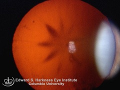 Snowflake Cataract